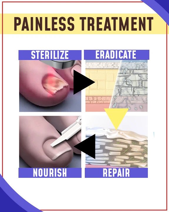 Juegos de tratamiento antimicóticos con luz azul - Image 2