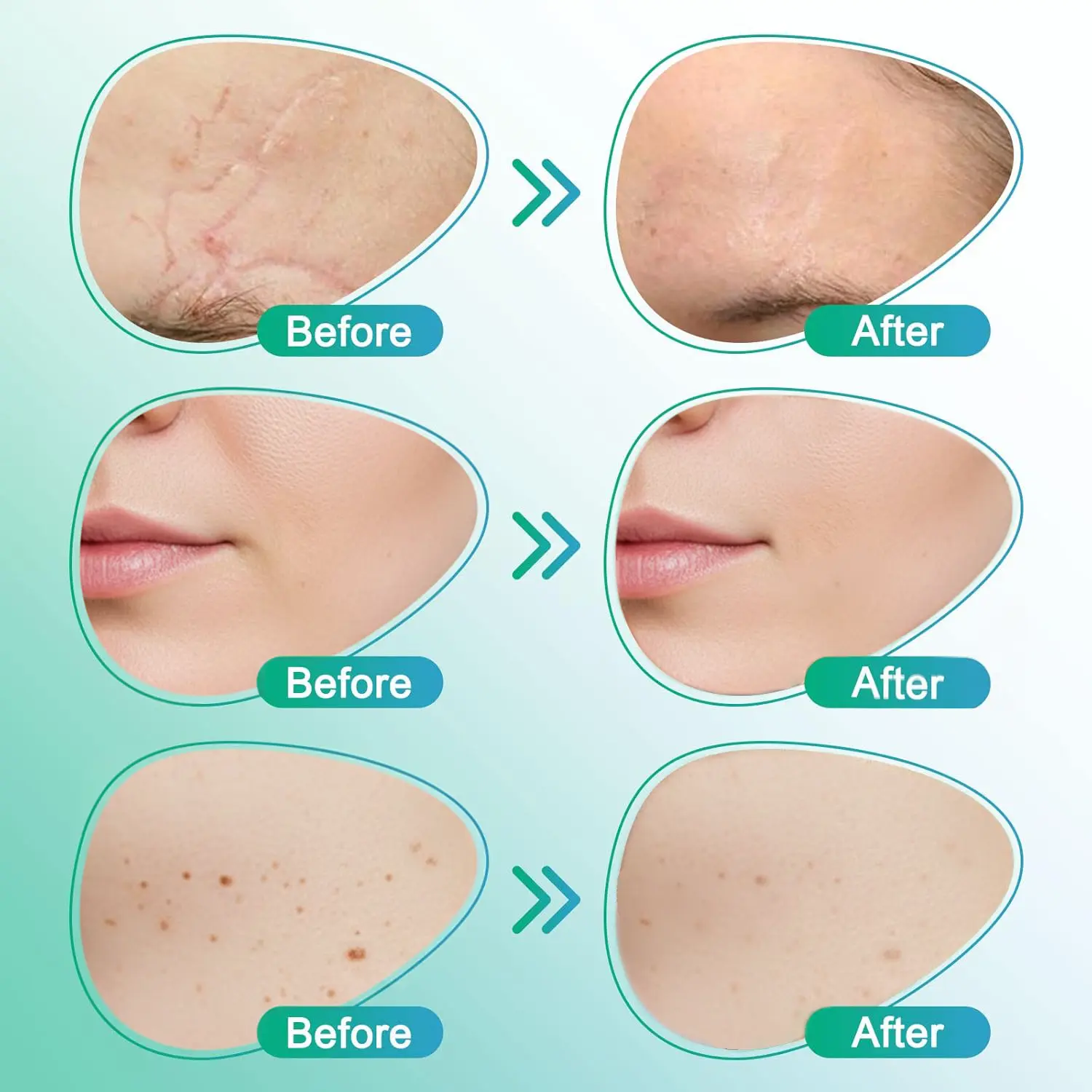 𝗖𝗮𝗿𝗲𝗕𝗿𝗲𝗲𝘇𝗲® Parche para el cuidado de microagujas 3 en 1 - Image 5