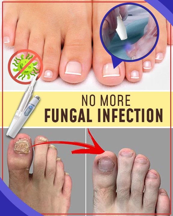 Juegos de tratamiento antimicóticos con luz azul - Image 3