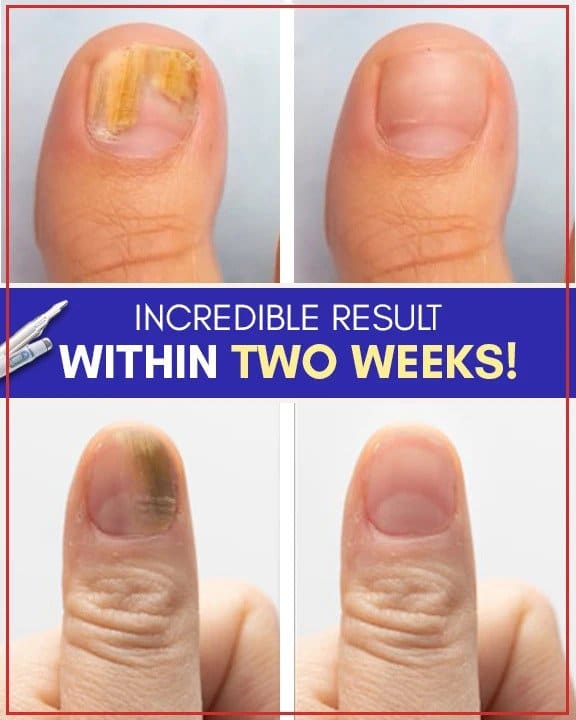 Juegos de tratamiento antimicóticos con luz azul - Image 5